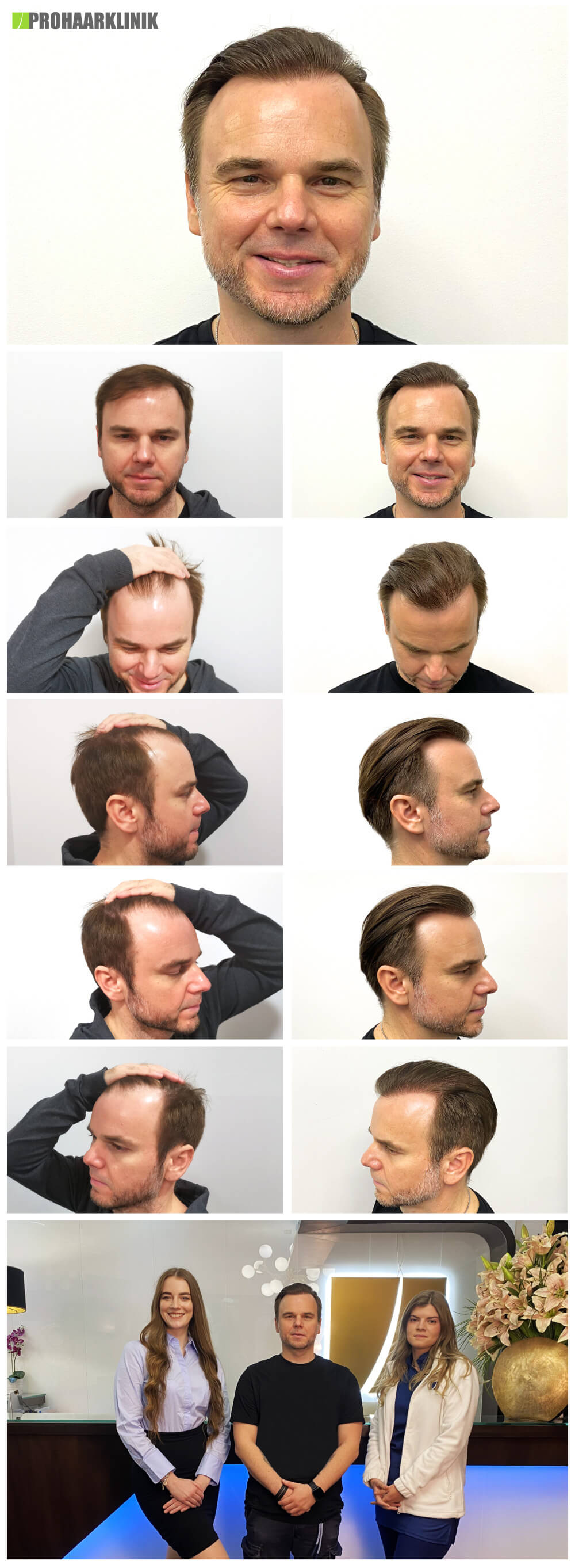 G. J. - Haartransplantationsergebnisse - vor und nach