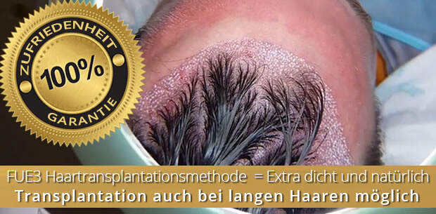 S.H.E. hajbeültetés S.H.E. hajbeültetés